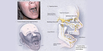 TRİGEMİNAL NEVRALJİ (YÜZ AĞRILARI) CERRAHİSİ 