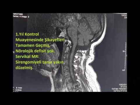 <p style="text-align: center;">BEYİNCİK SARKMASI</p>
<p style="text-align: center;">PROF DR. HİDAYET AKDEMİR</p>
<p style="text-align: center;">35 Yaş Cezayirli bayan: Baş d&ouml;nmesi dengesizlik kollarda g&uuml;&ccedil; ve duyu kaybı, N&ouml;rolojik Muay: Ataksi koordinasyon ve y&uuml;r&uuml;me bozukluğu Servikal MR: Arnold chiari Tip-1 + Sirongomiyeli. Posterior dekompresyon yapıldı. ameliyat sonrası şikayetleri tamamen iyileşti sirengomileli tama yakın kayboldu.</p>
