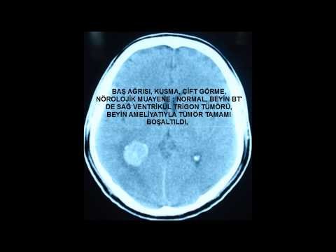 Baş ağrısı kusma &ccedil;ift g&ouml;rme şikayetleri olan hastanın beyin t&uuml;m&ouml;r&uuml; (ventr&uuml;k&uuml;l i&ccedil;erisi) beyin t&uuml;m&ouml;r&uuml; tespit edildi. mikroskopla t&uuml;m&ouml;r&uuml;n tamamı alındı. tatlil iyi huylu (menengiom). şikayetleri tamamen ge&ccedil;en hasta eski işine d&ouml;nd&uuml;.